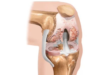 Arthrose of artritis van verschillen