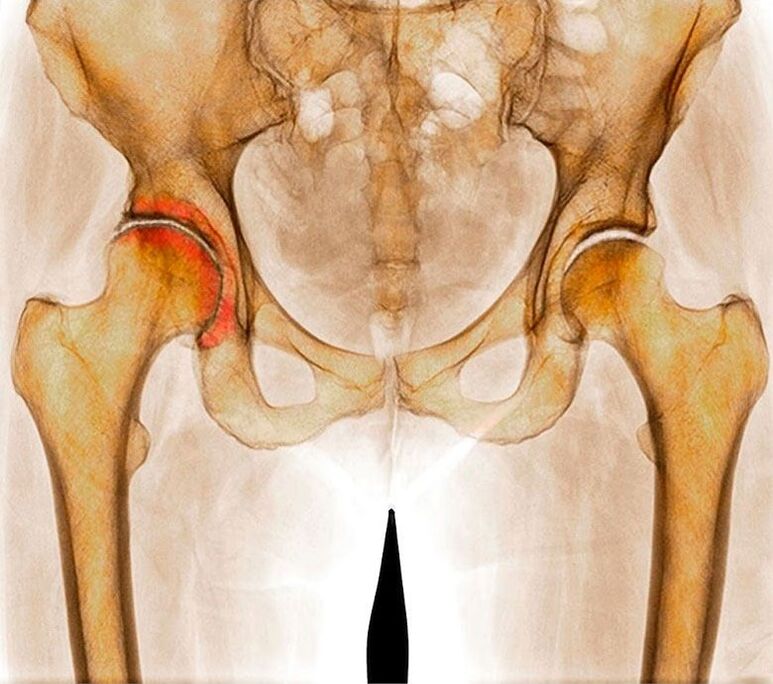 Arthrose van het heupgewricht