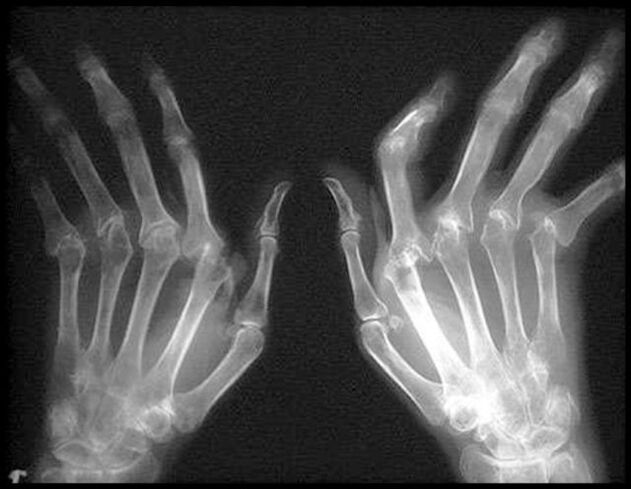 X -Ray foto van de handen die worden getroffen door artrose