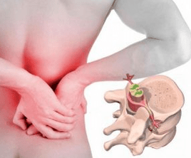Lumbago aan het begin van de ziekte osteochondrose