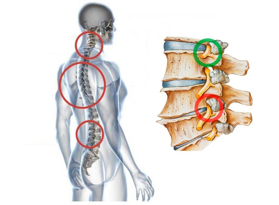 Hoe ziet de cervicale osteochondrose van de wervels eruit