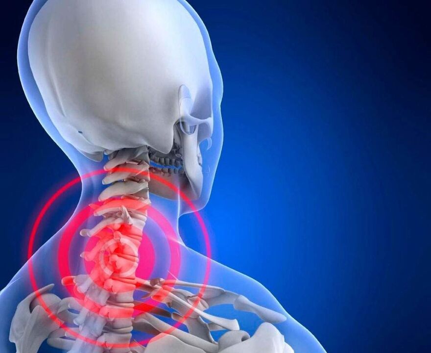 nekpijn met cervicale osteochondrose