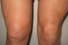 ontsteking in het kniegewricht met artritis en artrose