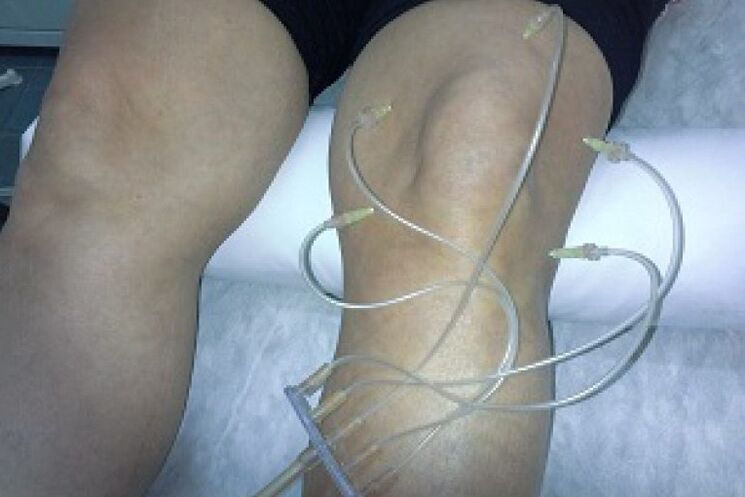 Ozon therapie