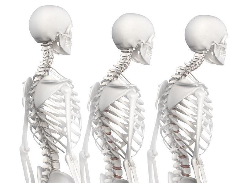 Graden van ontwikkeling van thoracale osteochondrose aan de hand van het voorbeeld van een skeletmodel